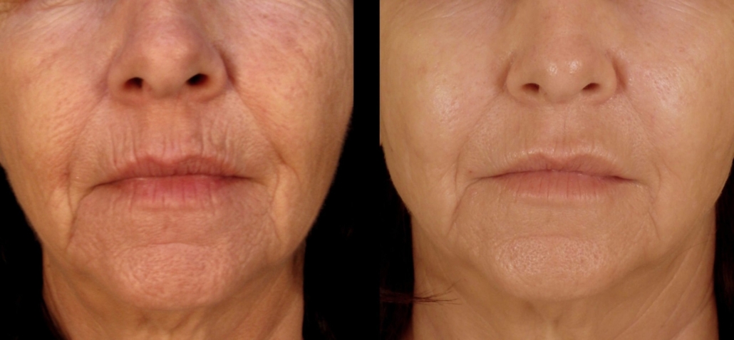 lifting-bodytite-02-scaled-1-2048x948